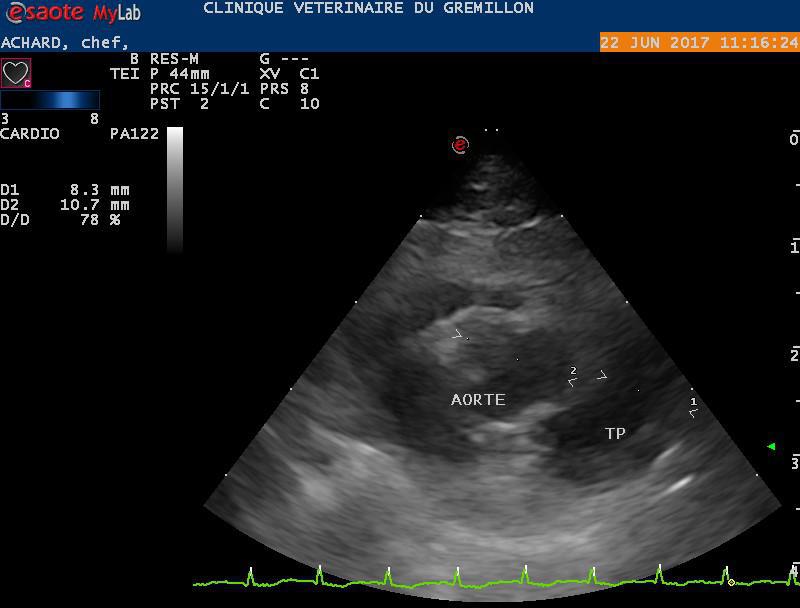Coupe trans aortique normale centré sur l'aorte