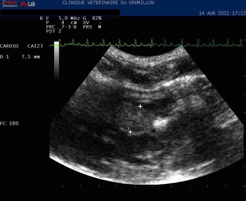 Epaississment du septum en region sous aortique: Sténose sous aortique