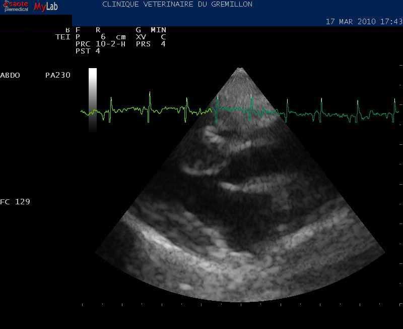 Bourrelet musculaire septal en region sous aortique: Sténose sous aortique