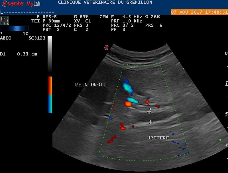 Dilatation de l'uretère suite à la présence d'un calcul de 3 mm encastré dans l'uretère