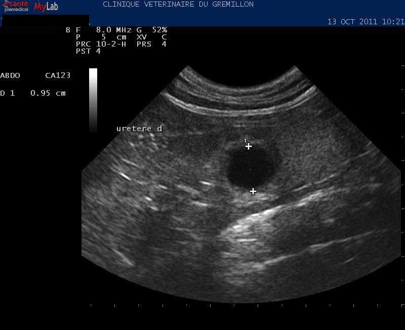 Uretère: dilatation en amont d'un calcul urinaire