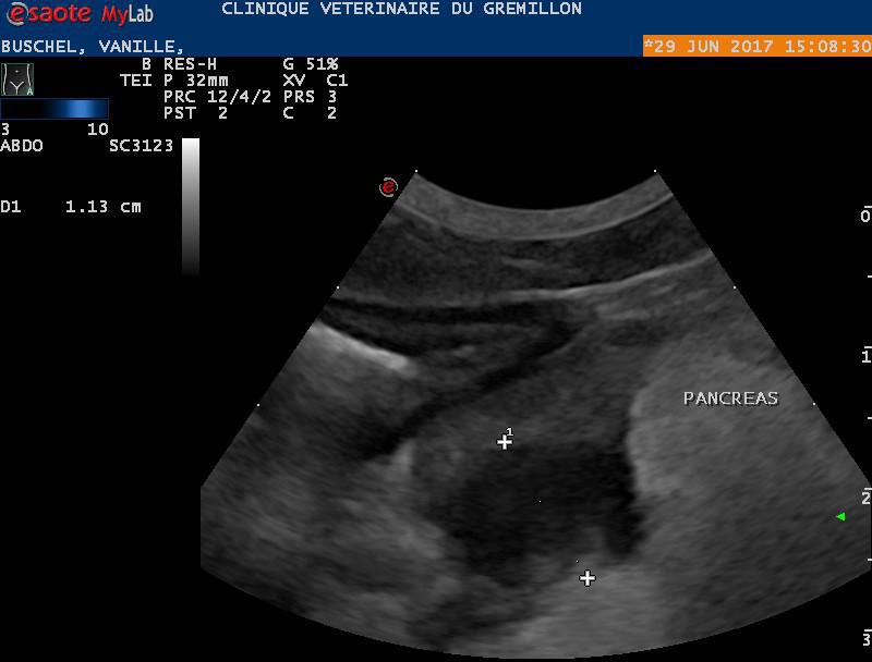 Pancreatite avec abces