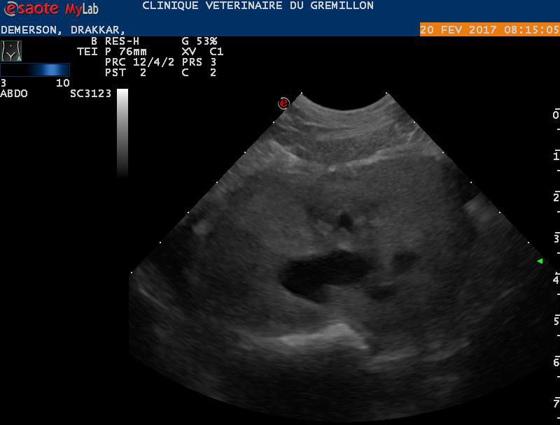 Hypertrophie d'une prostate, présence d'une caverne en continuité avec l'urètre
