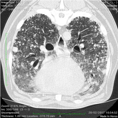 Tumeur pulmonaire diffuse sur un chat
