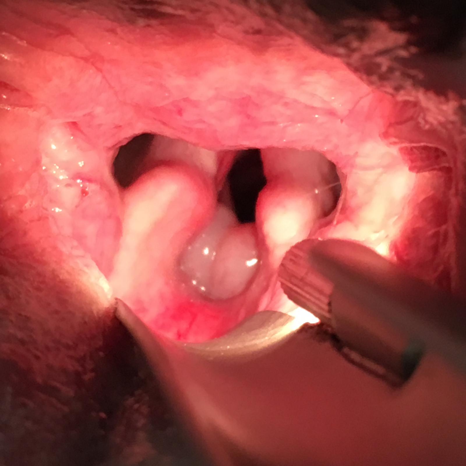 Diverticules laryngés à l'entrée du larynx