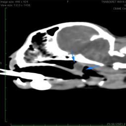 Polype naso-pharyngien visualisé au scanner