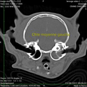 Otite moyenne: bulle tympanique opaque