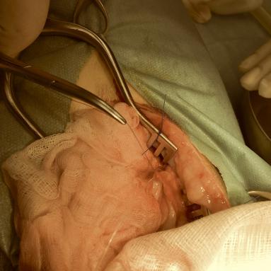 Cathétérisation uretère